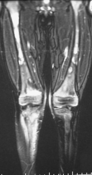Imagen de RM de miembros inferiores: alteración en la intensidad de la señal de la médula ósea que afecta fundamentalmente a la metáfisis femoral distal, metáfisis proximal peroneal y tibial derechas, con afectación de diáfisis femoral bilateral.
