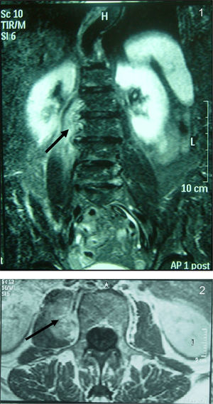 Resonancia magnética lumbar: se identifica una lesión que infiltra la musculatura del psoas derecha de aproximadamente 4,9cm y en íntimo contacto con las vértebras L2-L3.