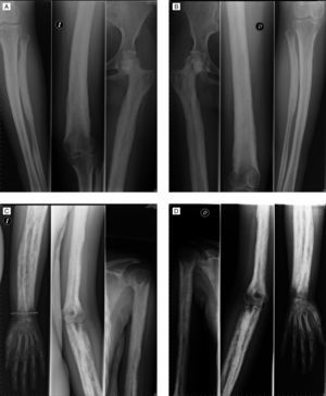 Imágenes de diáfisis de extremidades superiores e inferiores que muestran engrosamiento cortical y esclerosis de los huesos tubulares y osteoesclerosis irregular y heterogénea con áreas moteadas de radiolucencia.