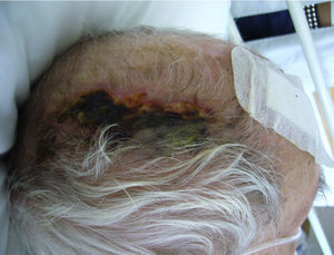 Necrosis cutánea en paciente con arteritis de la temporal.
