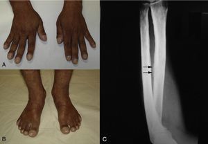 A) Hipocratismo digital y uñas «en vidrio de reloj». B) Aumento de las extremidades en dedos de los pies y uñas «en vidrio de reloj». C) Radiografía de antebrazo izquierdo que evidencia espesamiento cortical en radio y cúbito, además de reacción periosteal (flechas).