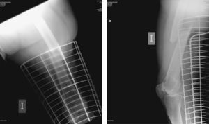 Patrón radiográfico característico de una fractura atípica de la diáfisis femoral en una mujer de 70 años tratada con aminobisfosfonatos de forma prolongada.