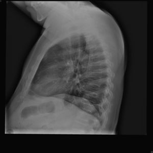 Radiografía lateral de tórax. Se aprecian cifosis dorsal, platiespondilia, irregularidades de los platillos de los cuerpos vertebrales y estrechamiento de los discos intervertebrales.