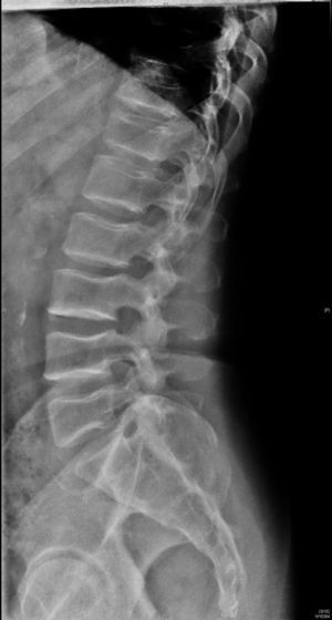 Radiografía lateral de la columna lumbar. Podemos observar platiespondilia, así como las porciones centrales y posteriores de las vértebras en forma de joroba.