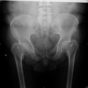 Radiografía anteroposterior de pelvis. Apreciamos acortamiento de los cuellos femorales, coxa vara bilateral y displasia en ambas cabezas femorales.
