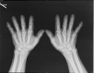 Radiografías posteroanteriores de las manos. Braquidactilia del segundo y el tercer dedo con acortamiento de las segundas falanges.