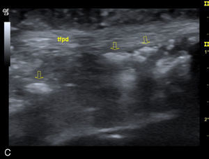 Imagen en proyección transversal (A) y longitudinal (B) del compartimento extensor 4, correspondiente al extensor común de los dedos. Imagen longitudinal correspondiente al flexor largo del pulgar (C), en escala de grises. En las imágenes transversales se ha anulado el software crossbeam, por el que se envían haces de ultrasonidos de forma oblicua que minimizan el artefacto ecográfico conocido como la sombra posterior, puesto que en este caso ese artefacto resulta de utilidad para evaluar las zonas de calcinosis. Se aprecia gran distensión de las vainas tendinosas de estos tendones, con la presencia de imágenes hiperecogénicas, de varios tamaños, con sombra acústica posterior (las flechas señalan las imágenes más llamativas), correspondiente a depósitos de hidroxiapatita. tecd: tendón extensor común de los dedos; tfpd: tendón flexor largo del primer dedo; r: radio. 