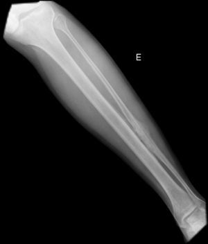 Radiografía simple de la pierna izquierda: imagen compatible de hiperostosis con cortical engrosada en el tercio medio de la tibia y el peroné que se extiende a lo largo del hueso mostrando una imagen de «chorro de vela fluyendo».