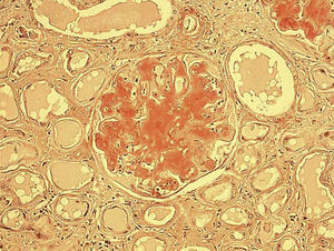 Biopsia renal: se observa depósito extracelular de un material filamentoso homogéneo acelular PAS +, rojo Congo +, de aspecto histológico glaseado y eosinófilo, denominado «amiloide». La preparación es de un corte renal teñido con rojo Congo, en el que apreciamos el amiloide como una sustancia homogénea teñida de un color rojizo-anaranjado que aparece engrosando el intersticio renal y obliterando las luces capilares glomerulares, llegando incluso a reemplazar al glomérulo (200x).