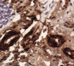 Biopsia de la mucosa intestinal: en el examen bajo luz polarizada se observa la típica refringencia del amiloide (Rojo Congo. 400x).