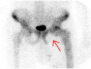 Gammagrafía ósea que mostró imágenes compatibles con enfermedad de Paget y ausencia de captación en isquion izquierdo.