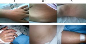 Máculas hipo/hiperpigmentadas en el hemicuerpo derecho. A) Mano derecha con contractura en flexión en el postoperatorio del túnel del carpo. B) Hemiabdomen derecho. C) Muslo derecho. Arriba, imágenes normales del hemicuerpo contralateral.