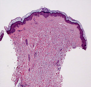 Biopsia cutánea que muestra engrosamiento dérmico a expensas de fibras de colágeno que se extienden hacia el subcutis.