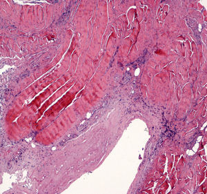 Biopsia del retináculo de los flexores del carpo derecho que muestra tejido fibroso aponeurótico y muscular estriado englobados en un estroma fibroso colágeno acompañado de un infiltrado inflamatorio mononuclear.