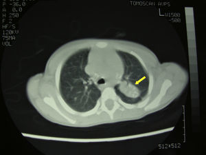 TC de tórax: adenopatías mediastínicas calcificadas con consolidación en segmento apicoposterior del lóbulo superior izquierdo, también calcificada.