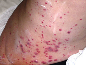 Presencia de púrpura palpable en una paciente con granulomatosis con poliangeítis (Wegener). Estas lesiones pueden verse prácticamente en cualquier caso de vasculitis primaria de vasos de pequeño calibre. Obsérvese cómo algunas lesiones coalescen y otras tienen centro necrótico.