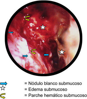 Lesiones características de actividad, corroboradas histolológicamente, en la fosa nasal derecha de un paciente con GPA y actividad severa. Beltrán et al.8.