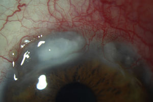 Queratitis ulcerativa periférica. Se observan dos áreas de lisis estromal corneal periférica superior.