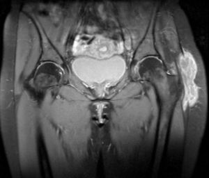 Colección bilobulada alrededor del trocánter mayor izquierdo de 6cm x 2cm x 10cm, con contenido heterogéneo.