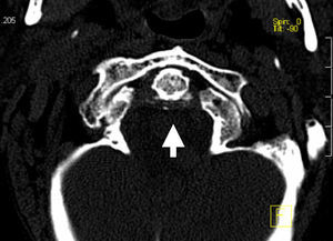 TC cervical: calcificación del ligamento transverso odontoideo (corte axial).