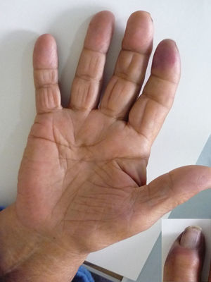 Visión palmar de la mano derecha y detalle del índice derecho.