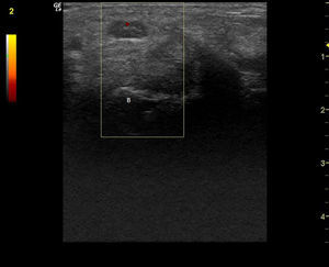 Corte transversal del nervio mediano en el túnel carpiano: arteria mediana remanente. (Imagen obtenida con ecógrafo General Electrics LOGIC e, con un transductor linear de 8-12 mHz, usando el Doppler de potencia con una frecuencia de 5,0MHz, ganancia de 12, PRF DE 1,2 hHz y filtro de pared de 180Hz).