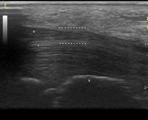 Corte longitudinal del nervio mediano derecho. (Imagen obtenida con ecógrafo General Electrics LOGIC e, con un transductor linear de 8-12 mHz usando para esta imagen una frecuencia de 12 mHz). B: hueso grande; N: nervio mediano; T: tendones flexores de la mano; *: zona de compresión.