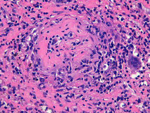 Vasculitis granulomatosa necrosante con células gigantes multinucleadas en arteriola pulmonar (HE × 400). Fotografía realizada por la Dra. Naranjo-Hans del servicio de anatomía patológica del Hospital Universitario Germans Trias i Pujol de uno de los pacientes de la serie.