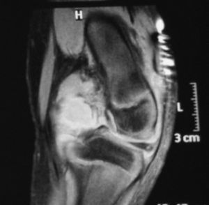 RM de rodilla izquierda. Ocupación de la cavidad articular que ocupa la escotadura intercondílea, recesos posteriores.
