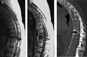 A y B: cortes sagitales de columna toracolumbar en secuencias potenciadas en T2 y T1, respectivamente. C: plano sagital de TC de columna toracolumbar. Se objetiva una alteración de la intensidad de señal medular a nivel D11-D12 que corresponde a una mielopatía compresiva. En el TC se observan signos de espondilitis anquilosante (fusión de las carillas articulares interapofisiarias y la osificación del ligamento vertebral común posterior) junto con signos degenerativos. A nivel de D11-D12 se observa como la mielopatía compresiva es secundaria a una fractura transdiscal de bloque vertebral.