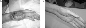 A) Pioderma gangrenoso: úlcera de contornos geográficos, con bordes violáceos y localizados sobre un nódulo eritematoso (lesión tras 24 h de administrar bolo de metilprednisolona, con evidente mejoría). B) Evolución favorable tras seis semanas de tratamiento con infliximab.