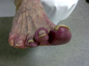 Acrocianosis en hortejos del pie derecho con el frío.