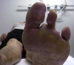 Amputación de varios hortejos del pie izquierdo.