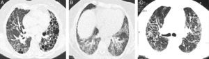 Representative CT images of RA-ILD patients. (A) Cystic lesions of subpleural and basal distribution resembling those seen in usual interstitial pneumonia, associated with areas of ground glass. (B) Ground glass with central distribution, respecting subpleural areas and discrete reticulation, resembling the pattern observed in the nonspecific interstitial pneumonia. (C) Reticulation and ground glass diffusely distributed, broncocentric, being an indeterminate pattern of interstitial lung disease.
