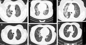 Basal CT images of a patient with ILD related to RA. (A) Multiple cystic images with perivascular and random distribution characteristic of lymphocityc interstitial pneumonia, and diffuse ground glass opacities and patchy areas of lung consolidations with broncocentric interstitium thickening. (B) One year follow up CT images after treatment with prednisone and methotrexate, showing less ground glass opacities, resolution of the consolidation areas and broncocentric interstitium thickening.