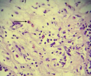 Biopsia de pulmonar por endoscopia que muestra expansión del intersticio, edema, acompañado de infiltrado linfoide mixto conformado por linfocitos, neutrófilos y eosinófilos (flecha). Hematoxilina y eosina × 40.
