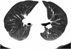Tomografía computarizada de alta resolución, con ventana a pulmón, que después de 3 meses de seguimiento muestra resolución completa del proceso inflamatorio neumónico.