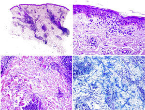 Lupus discoide: dermatitis perianexial linfocitaria (arriba izquierda) con vacuolización zonal de la basal epidérmica (arriba derecha). Abundantes depósitos de mucina en al dermis reticular (abajo izquierda) se hacen más patentes con técnica de hierro coloidal (abajo derecha).