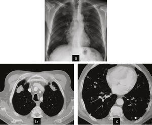 Caso 1. Nódulos típicos y atípicos. a) Radiografía de tórax preoperatoria con múltiples nódulos pulmonares. b) Tomografía computarizada de tórax: nódulos en lóbulos superiores de mayor tamaño, de contornos espiculados; se hizo biopsia percutánea para descartar neoplasia con el diagnóstico de nódulos reumatoides. c) Tomografía computarizada de tórax: en lóbulos inferiores nódulos redondeados, bien delimitados, subpleurales (pleural parietal, mediastínica, en cisuras (asterisco)), alguno aislado con cavitación (flecha) .Su apariencia radiológica es más típica de nódulos reumatoides.