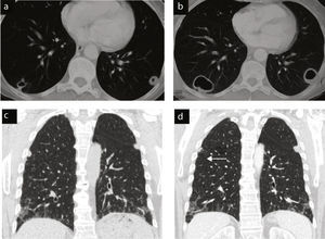Casos 2 y 3. Evolución de nódulos cavitados. a) y b) Caso 2: nódulos cavitados reumatoides que aumentan de tamaño. En la evolución se complicaron y produjeron un neumotórax por apertura del nódulo cavitado a pleura (imagen del neumotórax no mostrada). c) y d) Caso 3: nódulos subpleurales, redondeados, en paciente con signos de neumopatía intersticial. En la tomografía computarizada de control los nódulos han disminuido levemente de tamaño y uno se ha cavitado (flecha).
