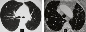 Casos 4 y 5. Distintos contextos clínicos: biopsia quirúrgica o control de imagen. a) Caso 5: tomografía computarizada de tórax: nódulos inespecíficos, en paciente sin diagnóstico de patología articular y con clínica respiratoria. Se hizo diagnóstico de granulomas necrotizantes con biopsia quirúrgica. La paciente desarrolló una artritis reumatoide un año después. b) Caso 4: tomografía computarizada de tórax: nódulos con semiología radiológica típica de nódulos reumatoide: redondeados, subpleurales, múltiples, en paciente con artritis reumatoide y neumopatía intersticial asociada. Se plantea seguimiento con controles de imagen.