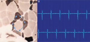 Descargas repetitivas de alta frecuencia. A) El potencial se origina espontáneamente en la fibra muscular número 1 y por transmisión efáptica, por contigüidad, pasa a la 2, y sucesivamente a la 3, 4, 5, 6 y de nuevo a la 1. B) El electromiograma recoge un potencial polifásico que se inicia y acaba bruscamente, que es siempre el mismo y dispara rítmicamente, y que tiene característicamente un sonido como el de una máquina, «chaca-chaca-chaca».