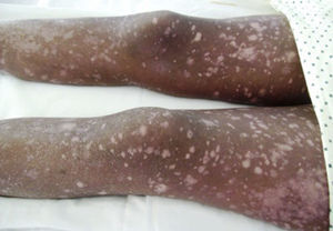 Imagen de las piernas con la característica alternancia de máculás hipo e hiperpigmentadas propias de la poiquiloderma.