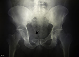 Radiografía de pelvis en la que se observa osteólisis (flecha) a nivel de la rama púbica superior, con márgenes óseos desflecados y pérdida de cortical, sin reacción perióstica.