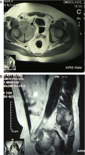A y B) RM caderas corte axial y coronal secuencia T2 con contraste. Se observa masa voluminosa en hemipelvis derecha, de 90×80×90mm (flechas), con componente osteolítico, que afecta a la mitad anterior del cotilo, el iliaco y la rama pubiana, desplaza a la izquierda a la vejiga urinaria y estructuras adyacentes, manifiesta señal isointensa con hueso y realce tras el contraste, excepto en focos de necrosis intensa.