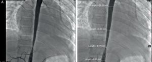 A y B) Cateterismo cardiaco: estenosis severa de la aorta toraco-abdominal. Gradiente de 50mmHg. Estenosis por debajo de las arterias renales no severa.