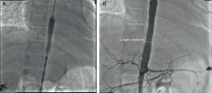 A y B) Angioplastia. Colocación de 2 stents largos, que cubren la zona de estenosis severa. Gradiente posquirúrgico: ninguno. Gradiente en la zona de estenosis renal: 10mmHg. No se realiza procedimiento en la arteria subclavia izquierda ni en las arterias renales.
