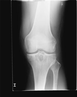 Radiografía de rodilla izquierda anteroposterior: se objetivan lesiones líticas de bordes bien delimitados en epífisis tibial y cambios degenerativos incipientes femorotibiales.