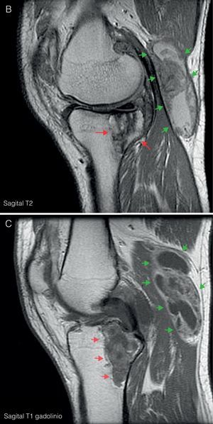 A) RM de rodilla izquierda corte coronal en T1. Muestra proliferación sinovial difusa hipointensa, con erosiones óseas en el margen posterolateral del cóndilo femoral (flecha azul) y en escotadura intercondílea. Lesión lítica hipointensa en epífisis proximal tibial con un diámetro máximo de 5cm (flechas rojas). B) Corte sagital en T2. Se observa un aumento heterogéneo de señal a nivel de la lesión lítica en epífisis tibial (flechas rojas); junto con un gran quiste de Baker situado por detrás del vientre muscular del gemelo interno (flechas verdes), con zonas de alta y baja señal, correspondientes a hipertrofia sinovial. C) Corte sagital en T1 con Gd. Tras la administración de gadolinio se objetiva realce periférico a nivel de la lesión lítica tibial (flechas rojas) y del quiste de Baker (flechas verdes).