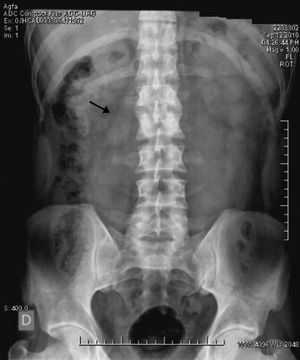 Borde de psoas derecho normal,borrado en lado izquierdo.
